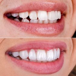 Porcelain-Veneers-before-and-after Porcelain-Veneers-before-and-after