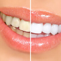teeth whitening Mouth and teeth before and after whitening